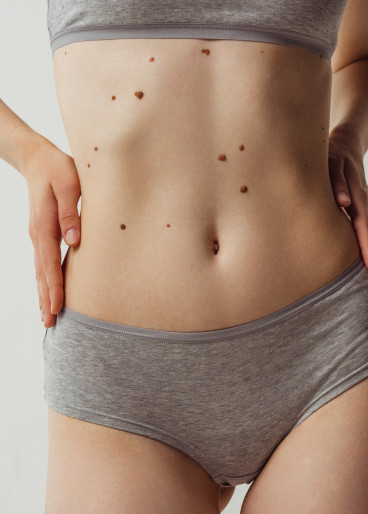 Frauenkörper mit vielen dunklen Muttermalen am Bauch.