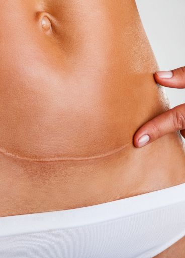 Das Bild zeigt den unteren Bauch einer Frau mit einer sichtbaren Narbe.
