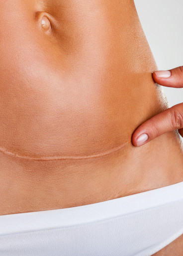 Das Bild zeigt den unteren Bauch einer Frau mit einer sichtbaren Narbe.